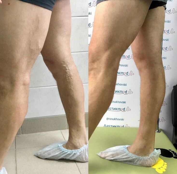 Experiență de utilizare Vasaxal
